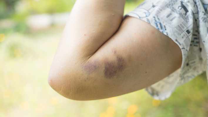 Bruise on womans arm