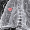 An X-ray of non-small cell lung cancer in a 54-year-old woman