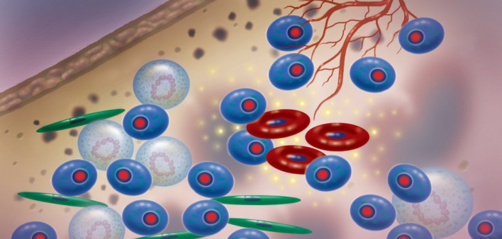 multiple myeloma