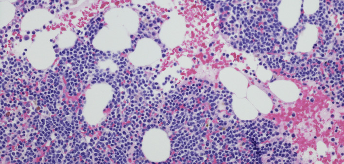 myeloma