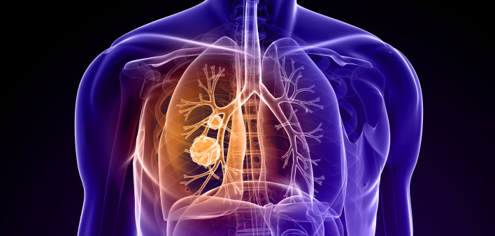Diagram of a torso showing site of cancer in the lung