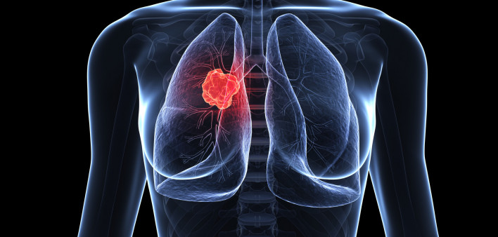 Illustration of woman with lung cancer