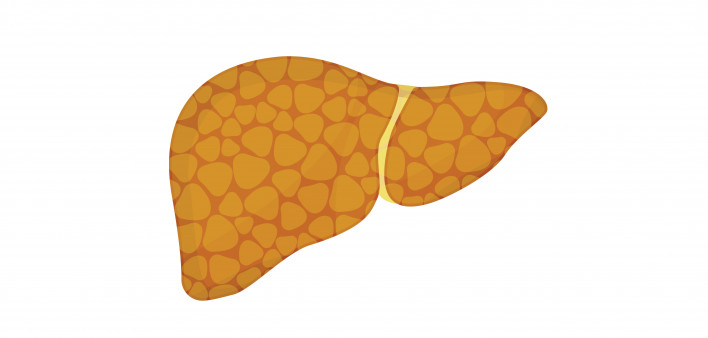 liver steatosis