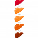 stages of liver disease