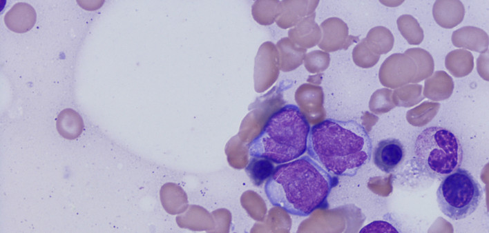 acute myeloid leukemia
