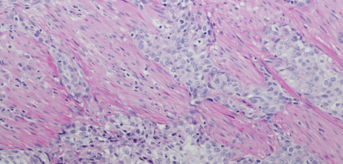urothelial carcinoma high grade