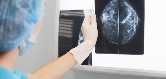 Woman doctor or nurse in surgery outfit is holding a mammogram in front of x-ray illuminator stock photo