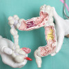 Colon cancer